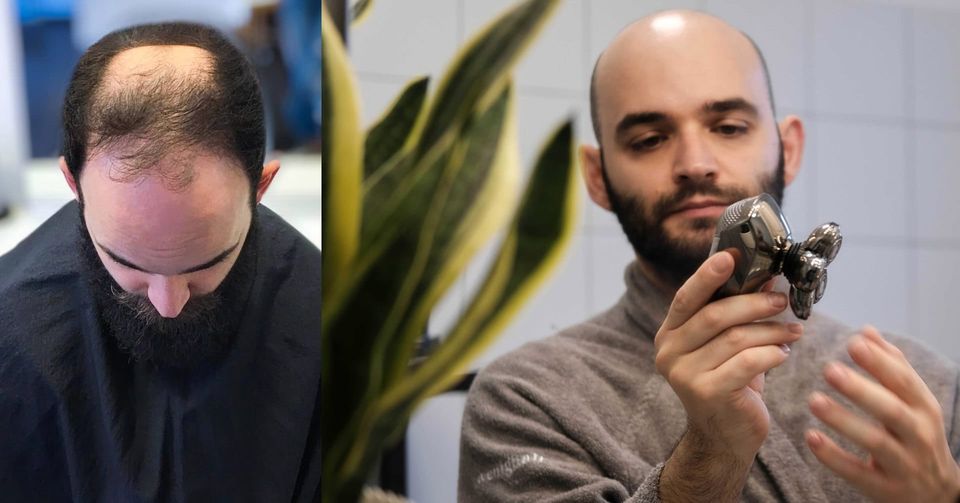 Vorher: Mann mit Haarausfall. Nachher: Derselbe Mann mit selbstbewusster Glatze und einem elektrischen Kopfrasierer in der Hand.
