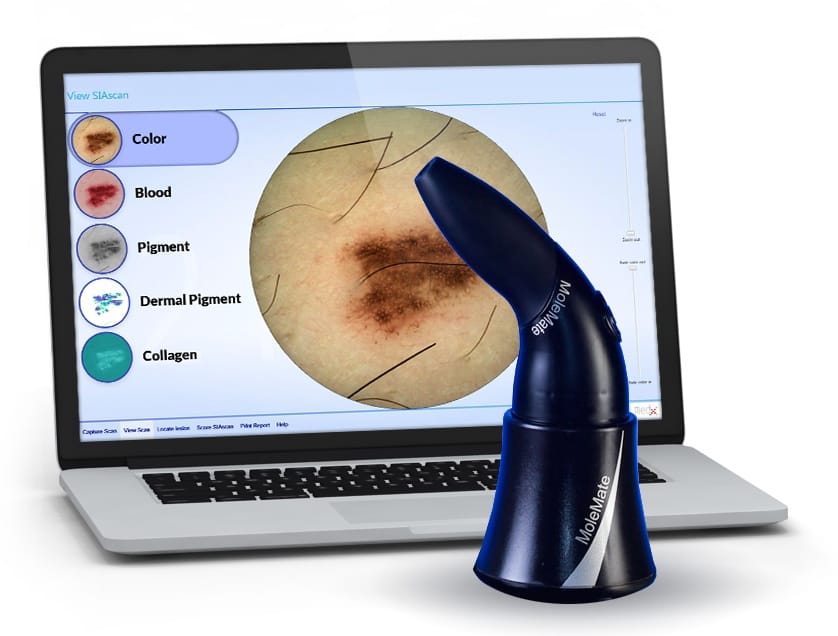 MedX MoleMate skin cancer scan