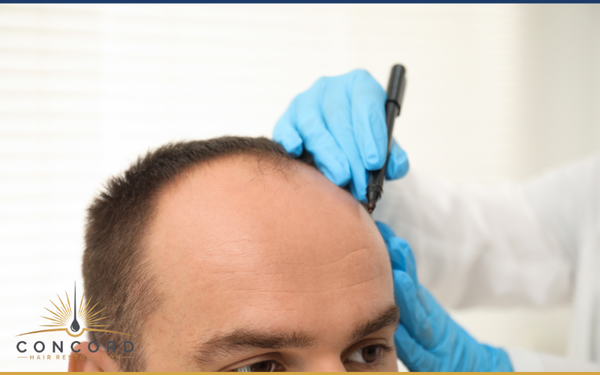Why Los Angeles Patients Are Becoming More Selective About Hair Transplants