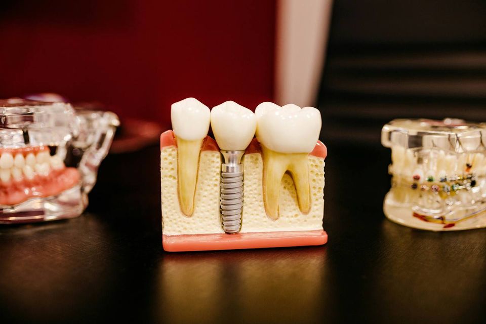 Where to Get Cheaper Dental Implants: Comparing Prices in the UK, Turkey, Georgia, Estonia, Germany, and Finland