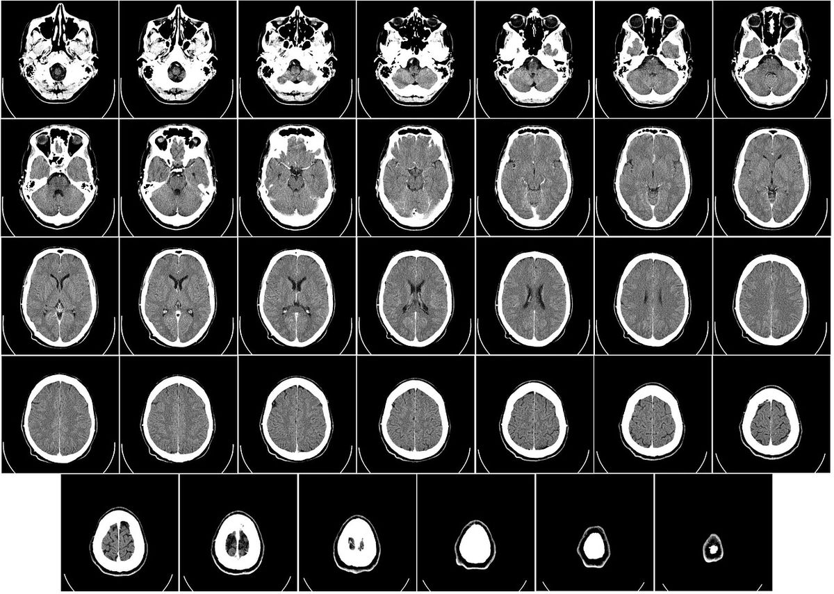 Cómo la ketamina puede cambiar el cerebro para combatir la depresión