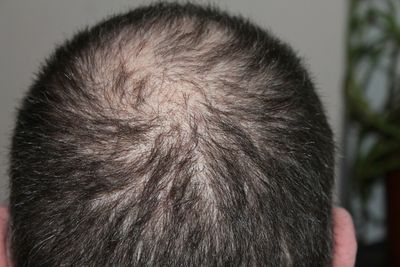 Caída del cabello: pistas encontradas en la palma de tu mano