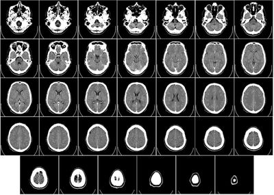 Cómo la ketamina puede cambiar el cerebro para combatir la depresión