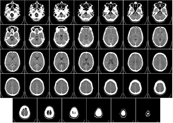 Cómo la ketamina puede cambiar el cerebro para combatir la depresión