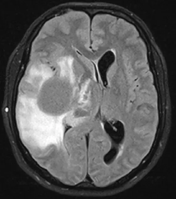 Una vacuna contra tumores cerebrales muestra resultados alentadores ocho años después