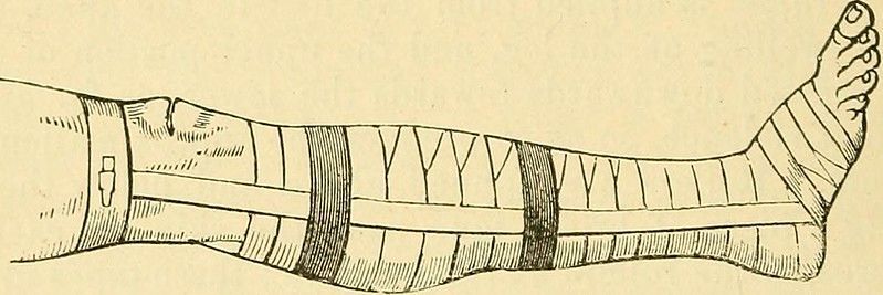 University of Bristol leads new research to identify genes implicated during scarring