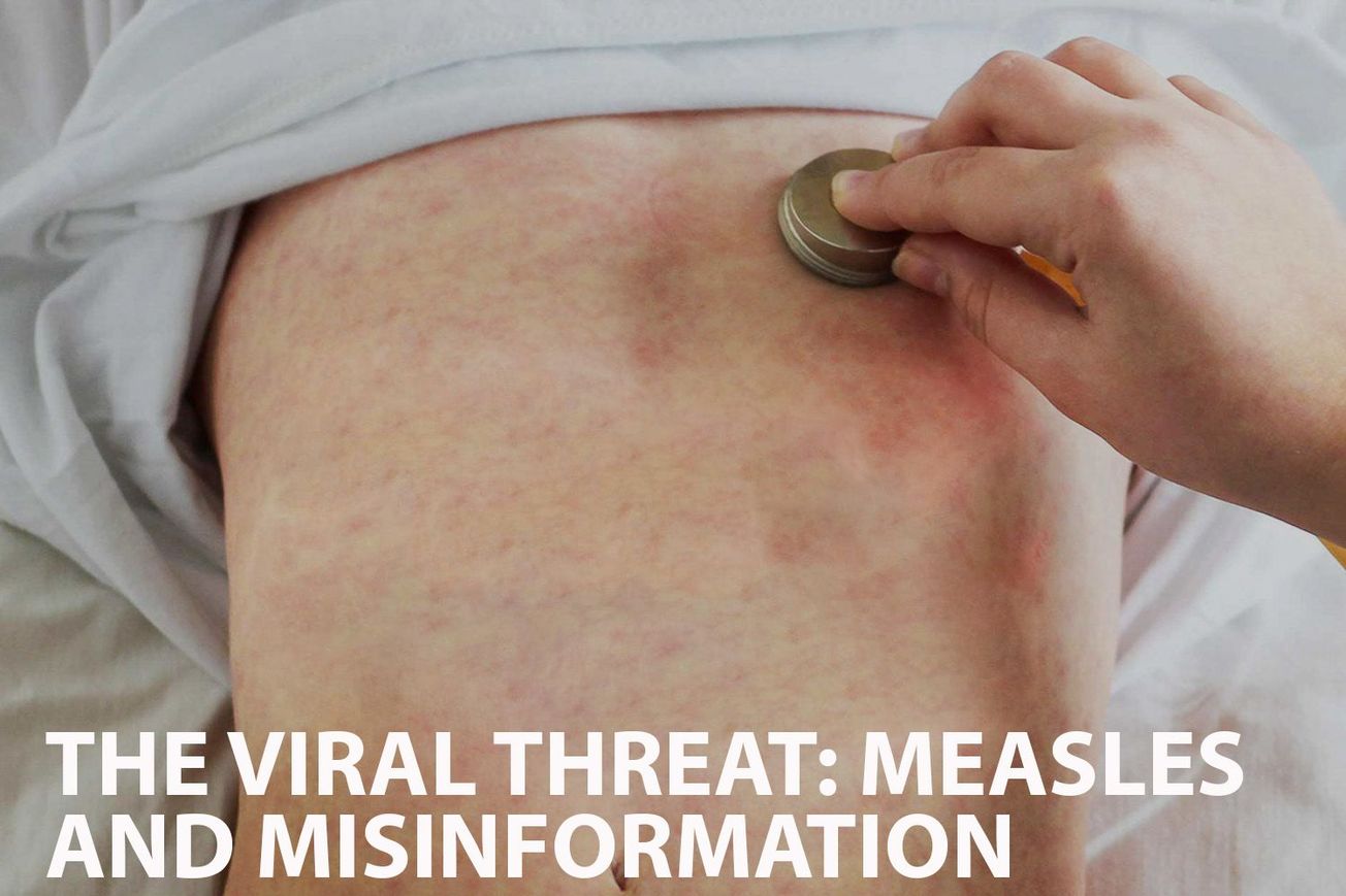 The Rise and Return of Measles