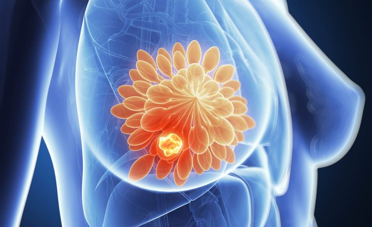 Breast Cancer