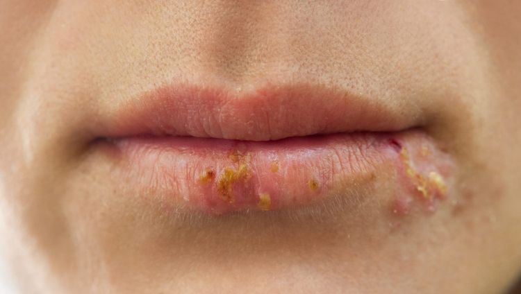 Herpes