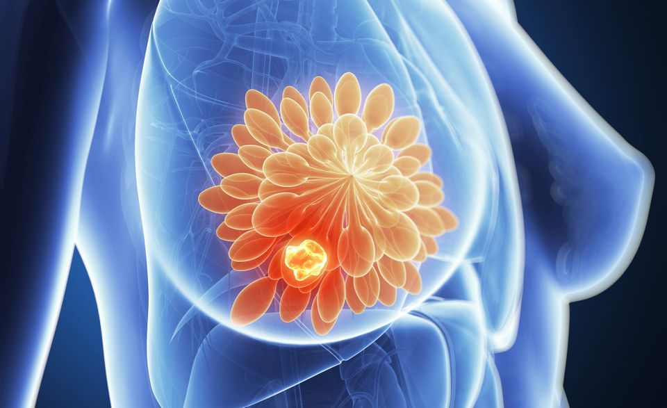 Breast Cancer