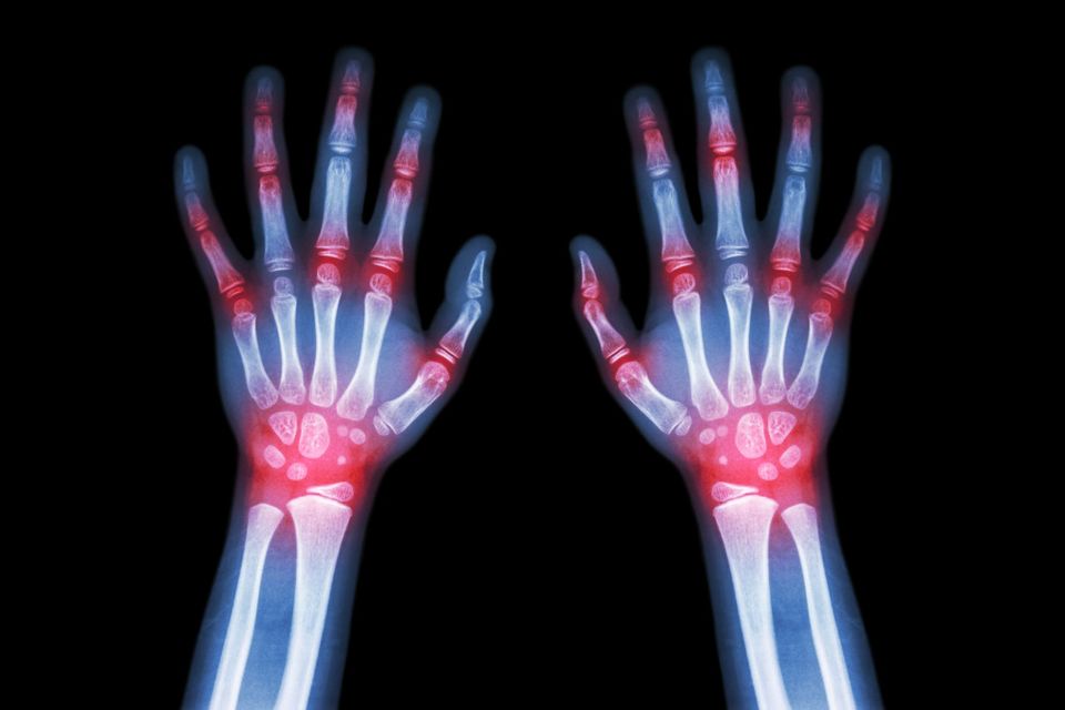Arthritis (Rheumatoid)