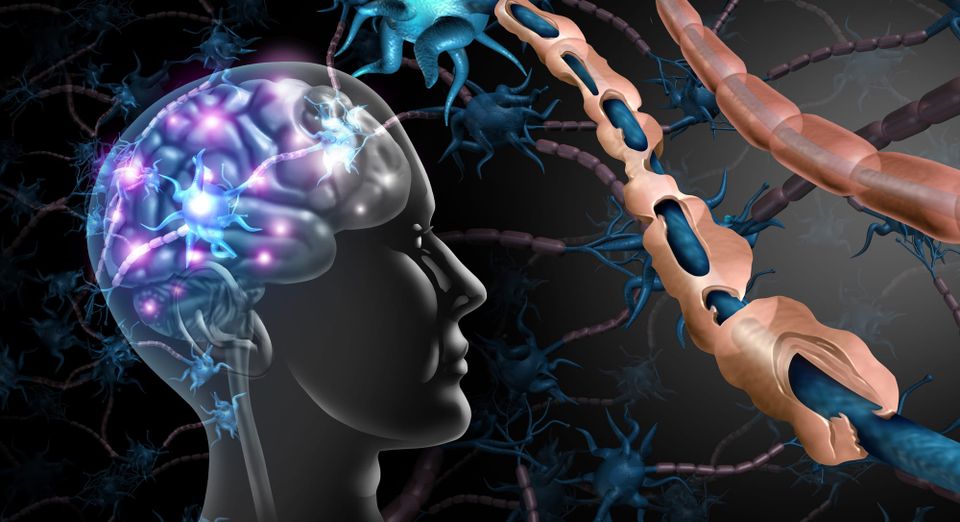Multiple Sclerosis (MS)