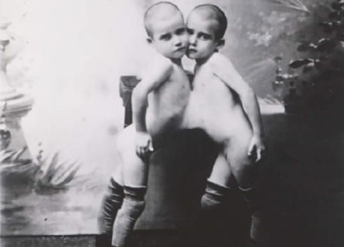         As meninas toracoxifópagas, Maria e Rosalina. Acervo internet