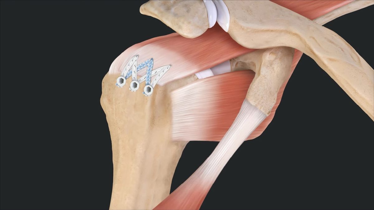 Recovering from rotator cuff surgery