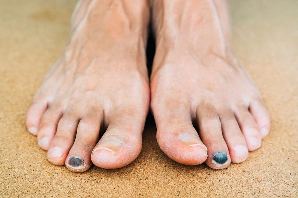 Runner's feet with black toenails