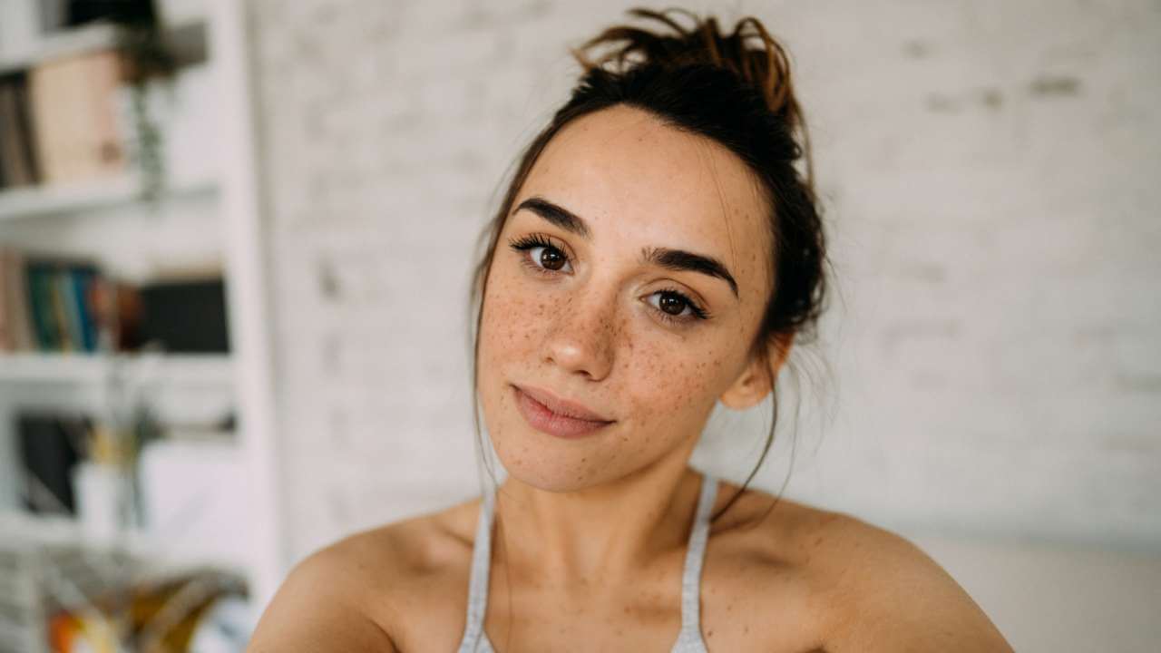 Young woman with dark spots on her face resulting from hyperpigmentation caused by acne marks. 