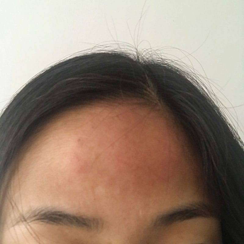 Swollen forehead from probable Lupus headaches.