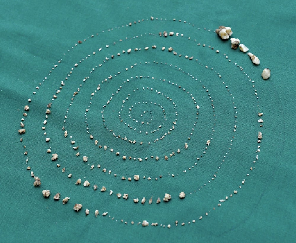 526 dents extraites garcon 7 ans