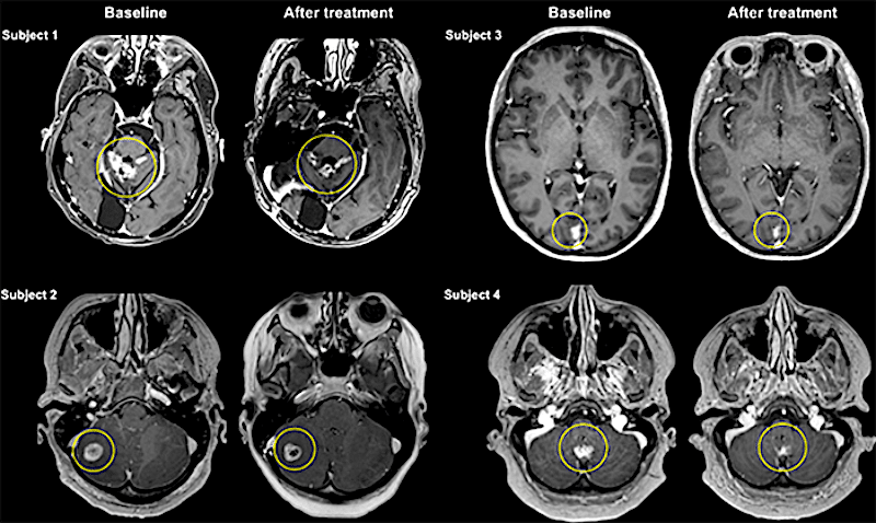 avant apres traitement ultrason barriere cerveau cancer