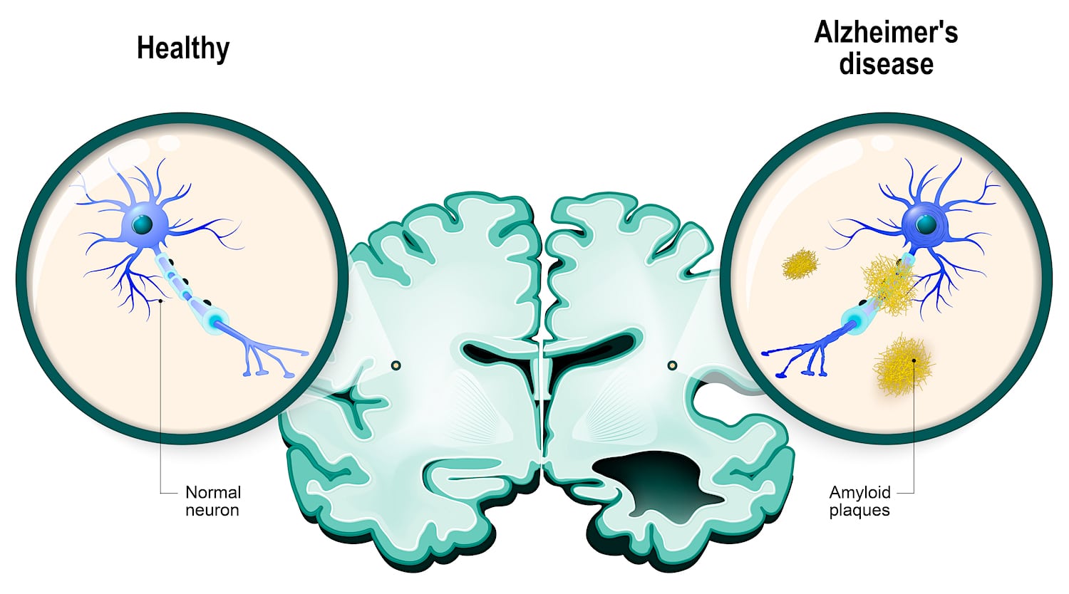 comparaison neurone sain alzheimer amyloides