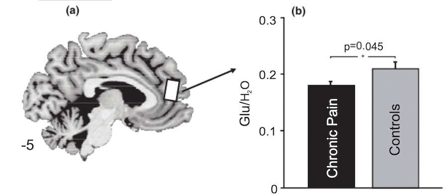 comparaison niveaux gaba douleur chronique temoins