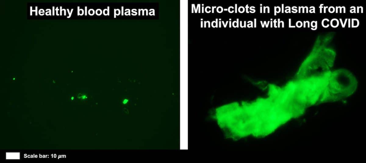 comparaison plasma caillots covid long
