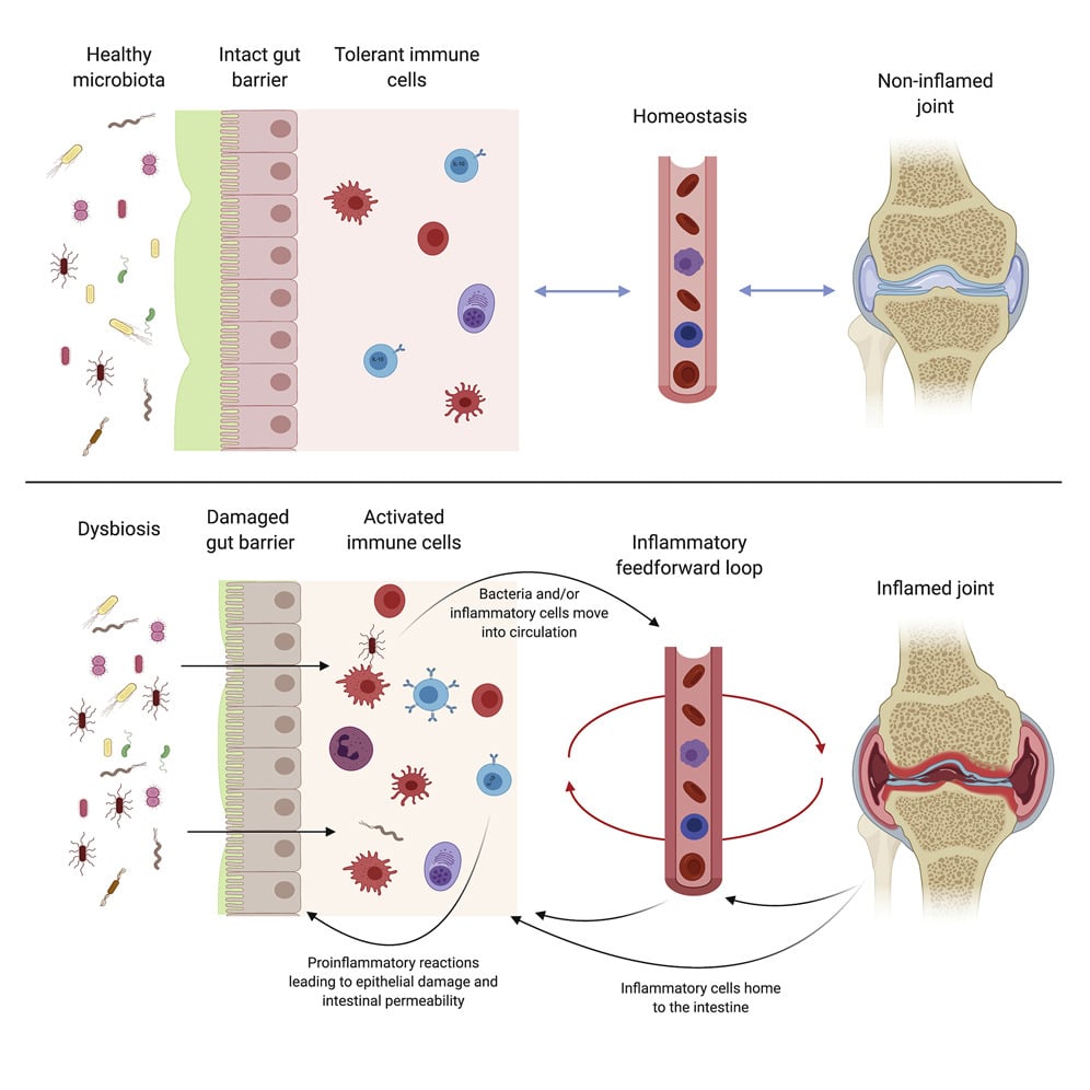 desequilibre microbiote intestinal inflammation polyarthrite rhumatoide schema