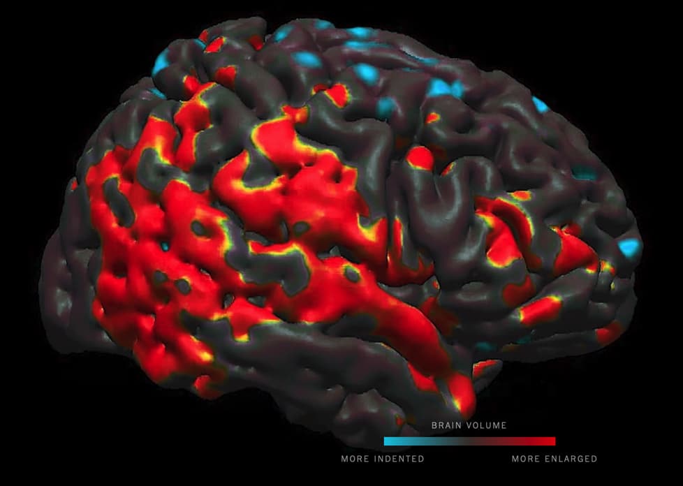 impact pesticides communs volume cerveau enfants