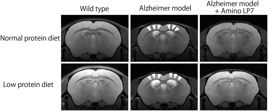 irm effets amino lp7 regime alimentaire atrophie cerebrale