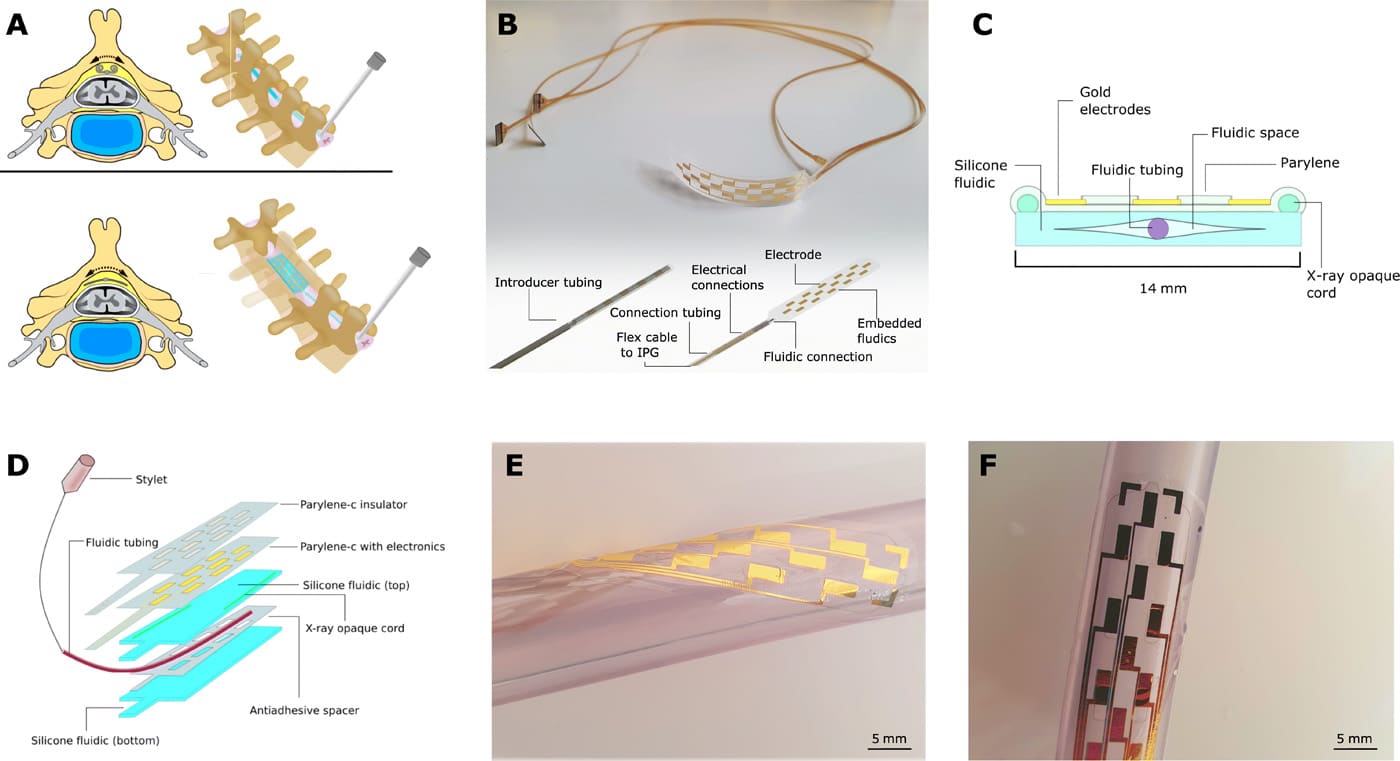 schema dispositif stimulation douleur chronique