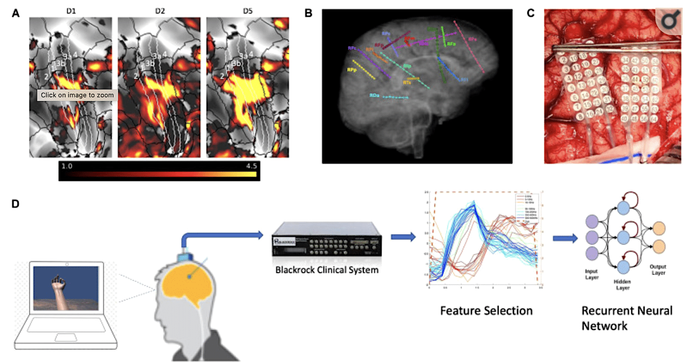 schemas test implant cerebral controle membres electrodes