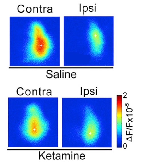 traitement amblyopie ketamine reponse corticale