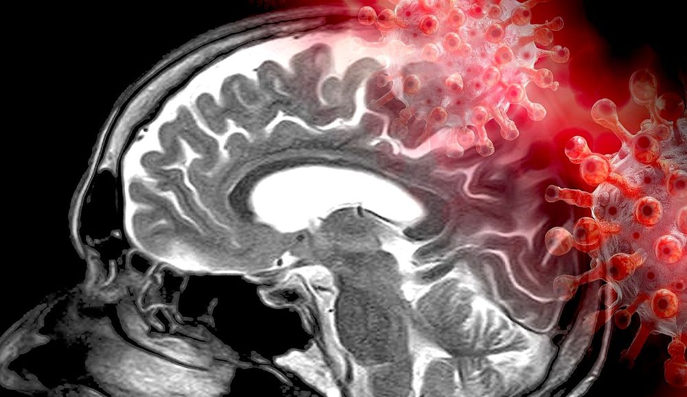 Détection d'anomalies cérébrales post-COVID, dont certaines restent incomprises