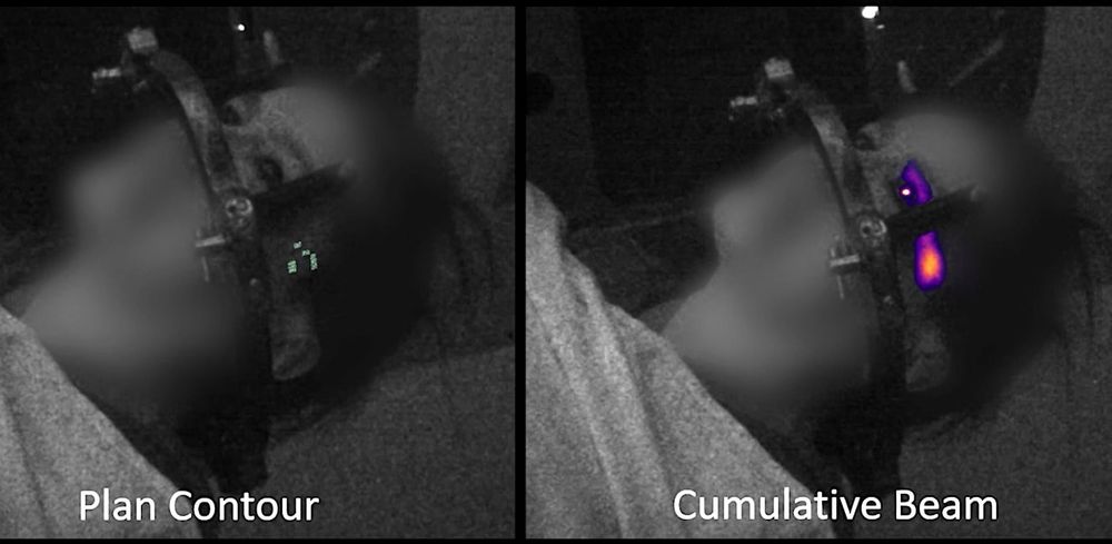 Radiothérapies : un étrange phénomène oculaire lumineux filmé pour la première fois