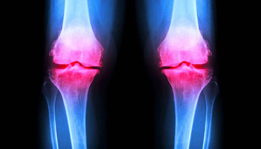 Un hydrogel injectable pour régénérer le cartilage endommagé des articulations