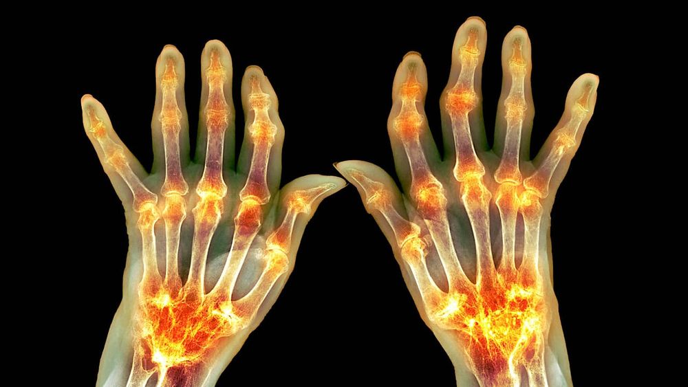 La polyarthrite rhumatoïde serait liée à un déséquilibre du microbiote intestinal