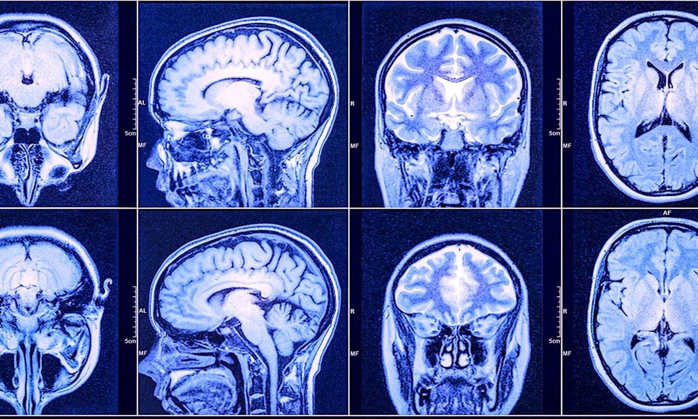 Un nouveau traitement prometteur contre le glioblastome, le cancer du cerveau le plus fréquent et agressif