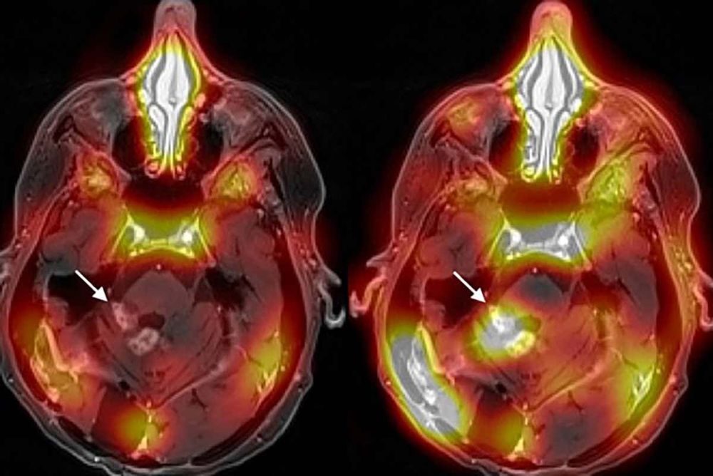 Première mondiale : une méthode pour traiter le cancer du cerveau en franchissant la barrière hémato-encéphalique
