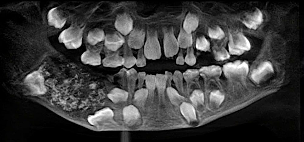 Des dentistes ont retiré plus de 500 dents de la bouche d'un garçon de 7 ans