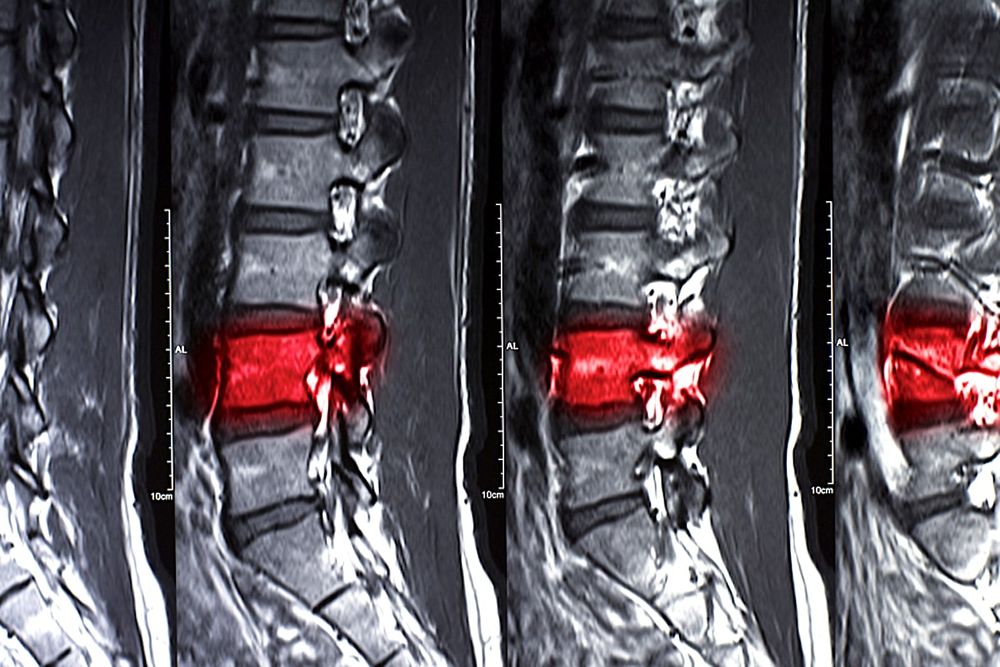 Réparer la moelle épinière en utilisant les cellules souches des patients