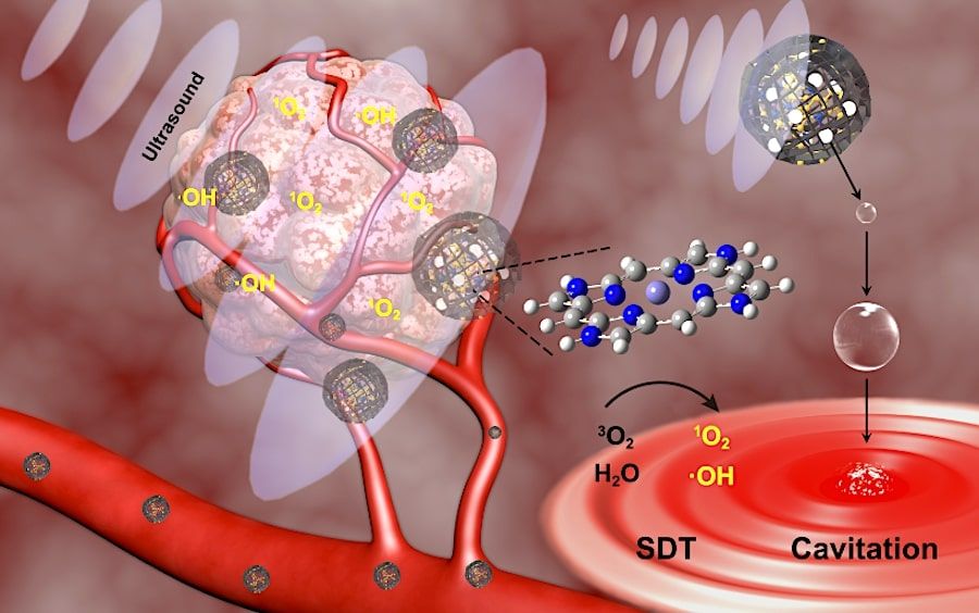 Une nouvelle forme de thérapie par ultrasons permet de neutraliser sélectivement les cellules cancéreuses, épargnant les cellules saines
