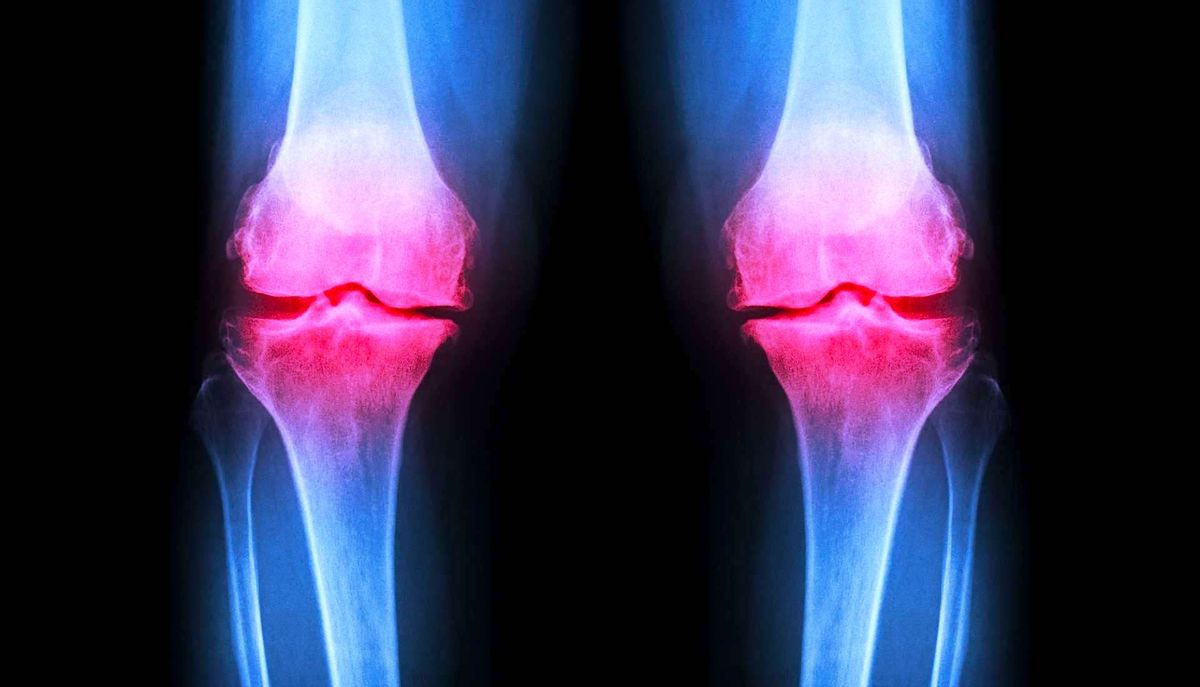 Un hydrogel injectable pour régénérer le cartilage endommagé des articulations