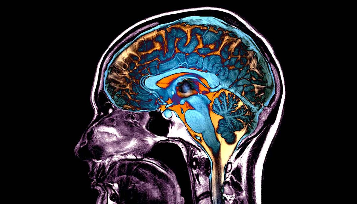 Les modifications cérébrales provoquées par la COVID auraient un impact sur la conscience et la cognition