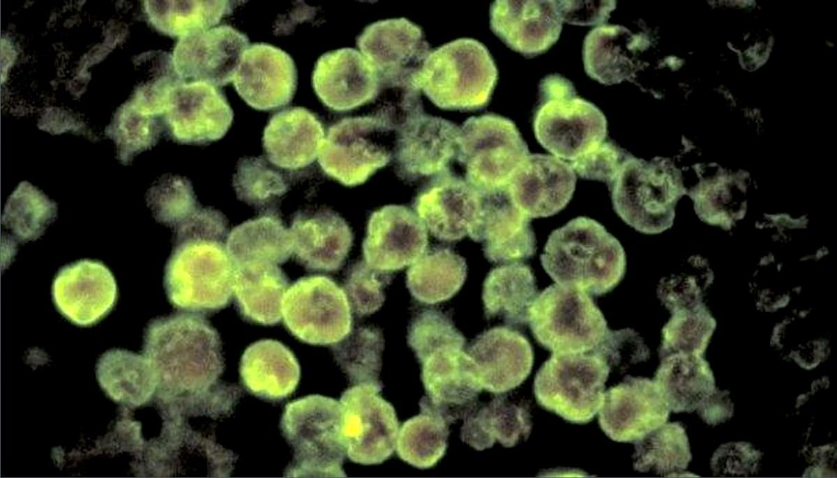Un américain meurt après avoir avalé une amibe "mangeuse de cerveau" lors d'une baignade