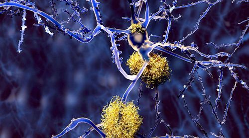 Le CBD réduirait les plaques amyloïdes et améliorerait la cognition chez les personnes atteintes d'Alzheimer