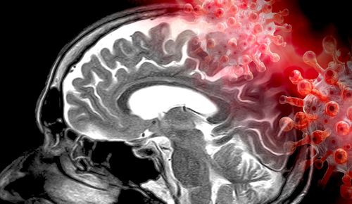 Détection d'anomalies cérébrales post-COVID, dont certaines restent incomprises