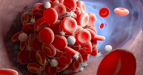 Le COVID long serait en partie dû à une surcharge de molécules inflammatoires piégées dans des micro-caillots sanguins