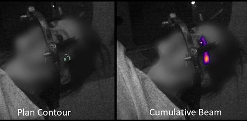 Radiothérapies : un étrange phénomène oculaire lumineux filmé pour la première fois