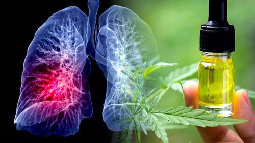 Une femme s'auto-traitant uniquement avec du CBD voit la taille de sa tumeur régresser de 76%