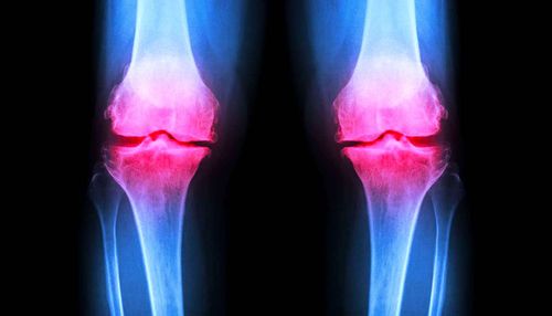 Un hydrogel injectable pour régénérer le cartilage endommagé des articulations